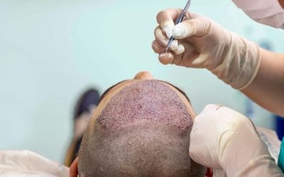 how to select the best hair transplant surgeon for your needs 1