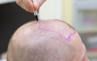 maximizing the benefits of hair transplantation