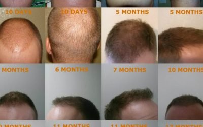 the advantages of hair restoration surgery