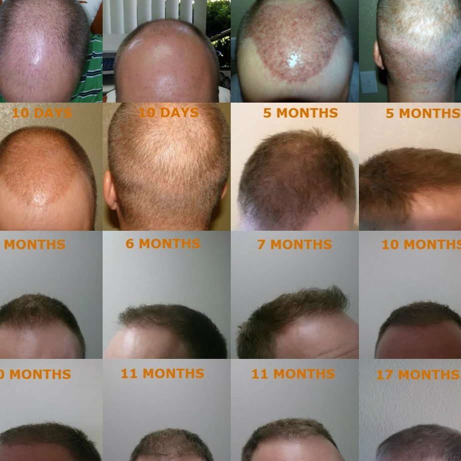 the advantages of hair restoration surgery