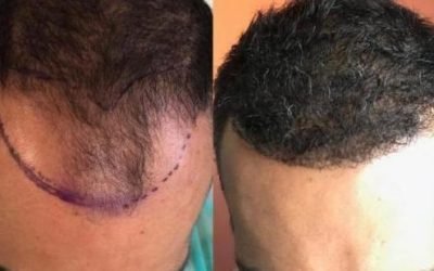the cost of hair transplant procedures 3