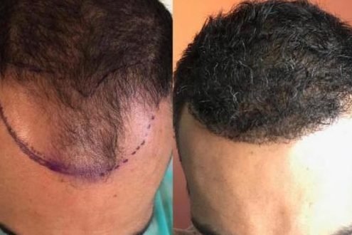 the cost of hair transplant procedures 3