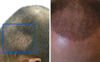 what to expect after a hair transplant 1