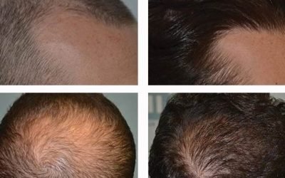 assessing the risks of hair transplant surgery 1