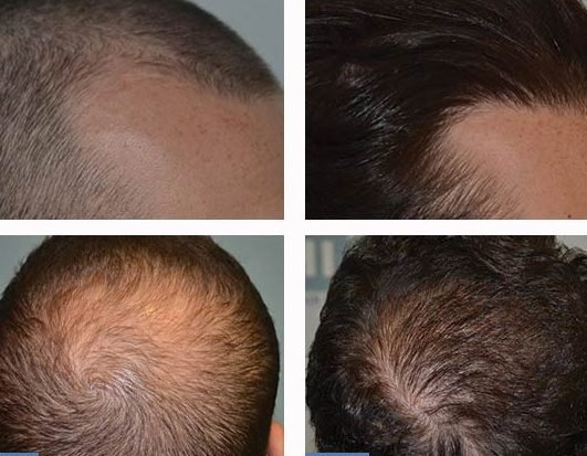 assessing the risks of hair transplant surgery 1