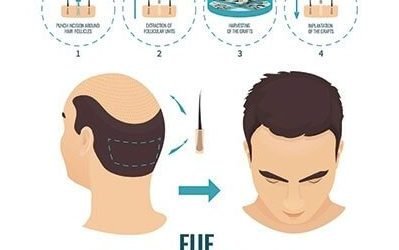 benefits of hair transplantation