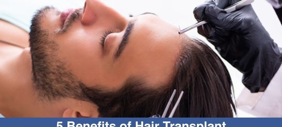 exploring the benefits of hair transplant surgery