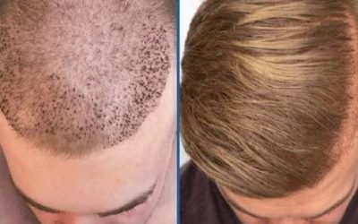 hair transplant an overview