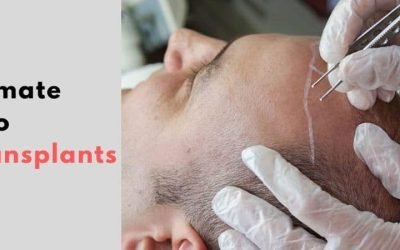 hair transplant maintenance how to keep results