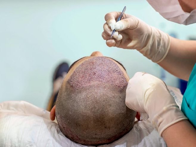 hair transplant recovery what to expect