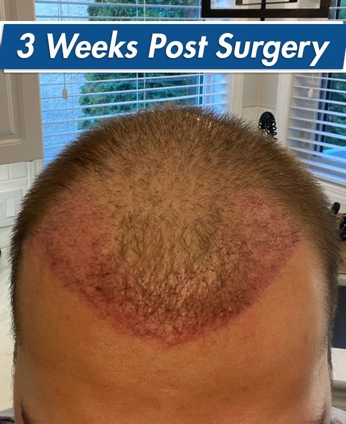hair transplant surgery what to expect