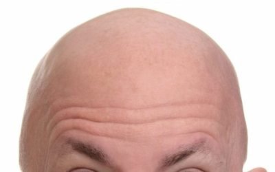 hair transplant the pros and cons 2