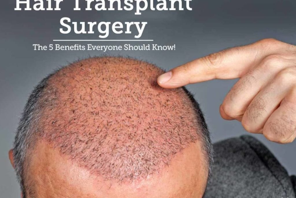 hair transplants the pros and cons