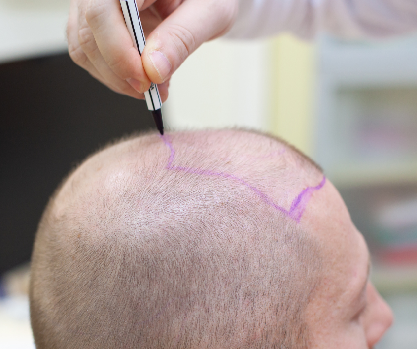 maximizing the benefits of hair transplantation