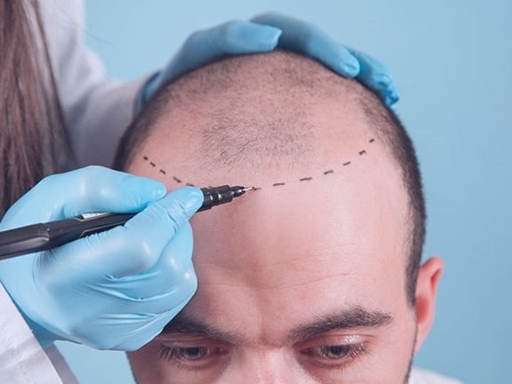pre and post care for hair transplantation 1