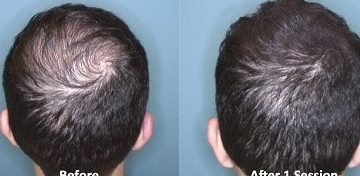 pros and cons of hair transplant