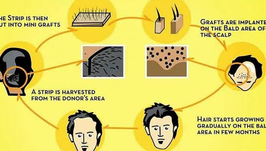 the benefits of hair transplant surgery a look into the healthier fuller you 1