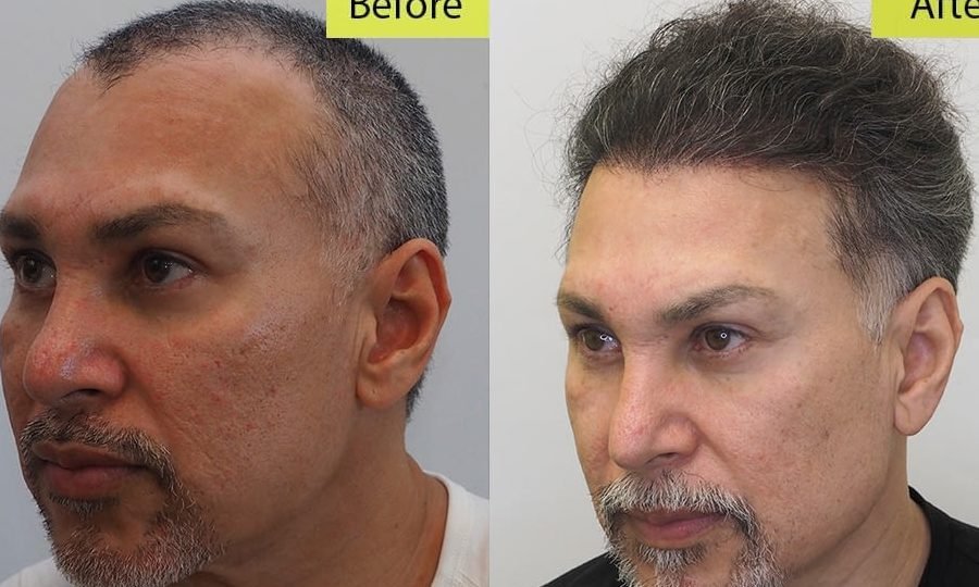 the cost of hair transplant surgery