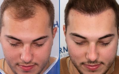 the different types of hair transplant surgery