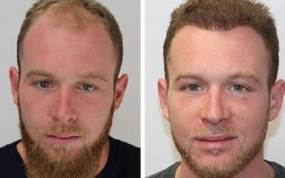 the different types of hair transplant techniquesthe latest trends in hair transplant surgery