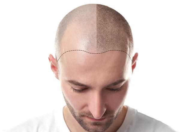 the pros and cons of hair transplantation