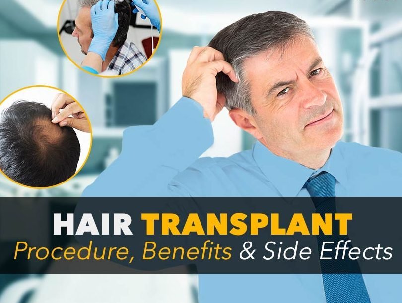 understanding hair transplant surgery benefits and risks