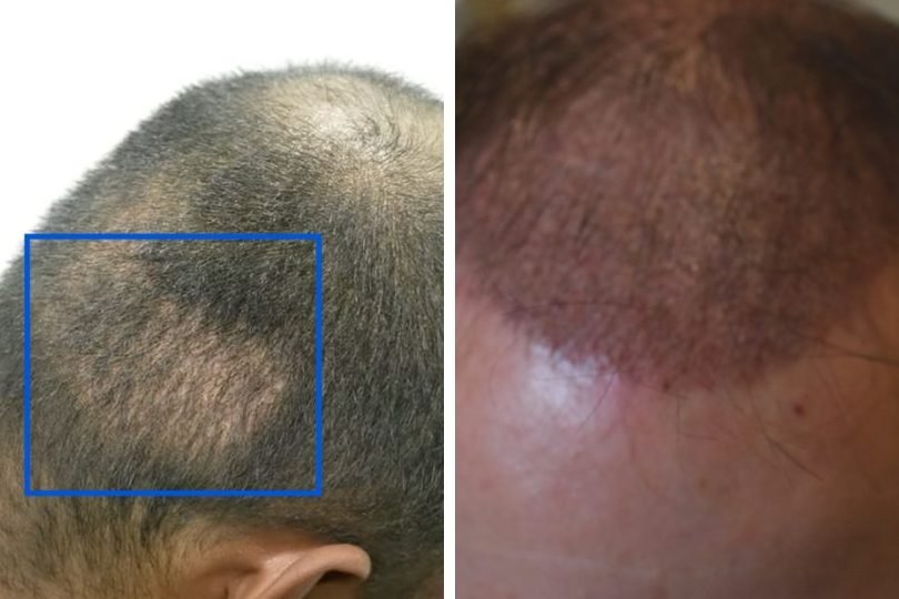 what to expect after a hair transplant 1